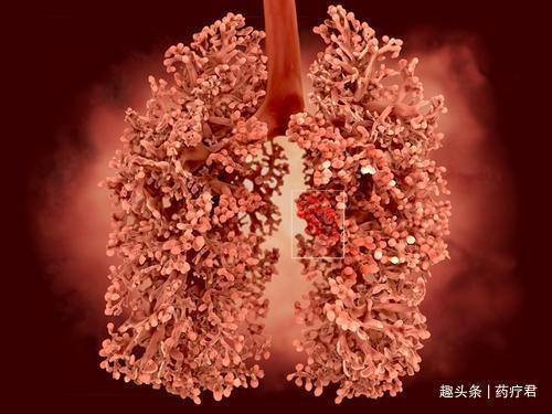 牙疼|男子肩膀疼,以为肩周炎,结果竟查出了癌症!提醒这里疼别大意