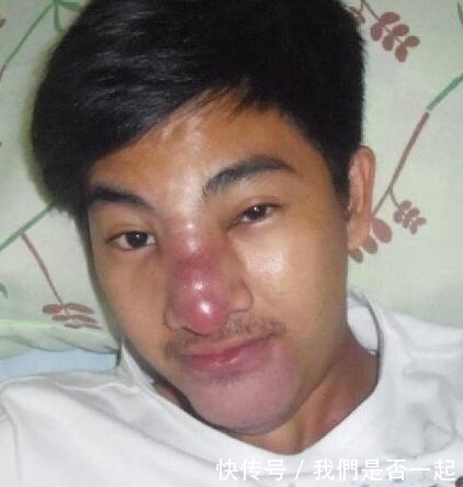 小伙花费70元整容,结果整容失败致脸部溃烂,帅小伙变成“丑男”