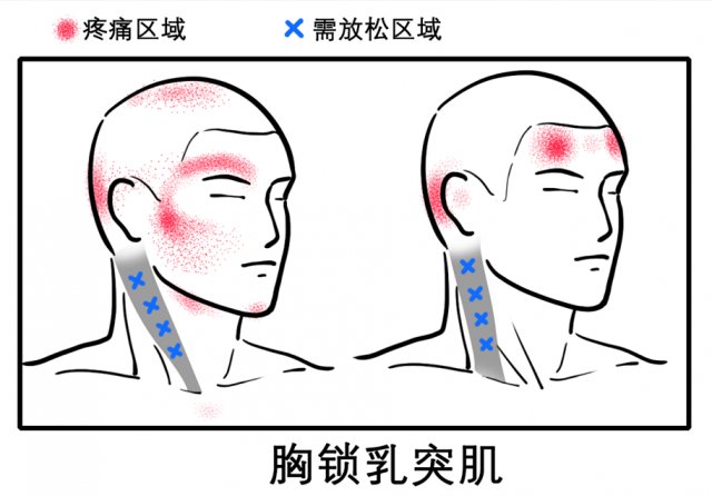 颈椎|八成头痛和颈椎有关！一份“疼痛位置图解”帮你对症放松