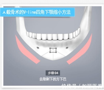 操作方法 下巴截骨术危险吗?手术注意事项须知及术后怎么护理?看完全明白了!