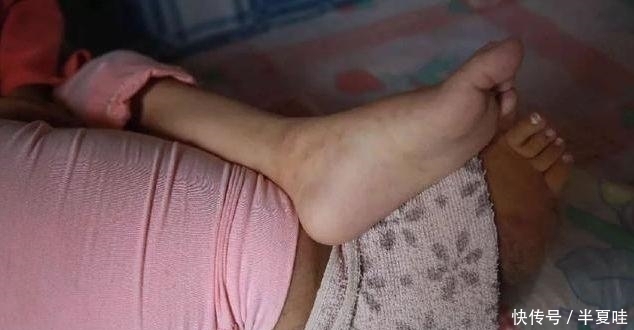 治病|5岁女孩因没钱治病,拖着象腿一样粗的大腿,每天吃止痛片止痛
