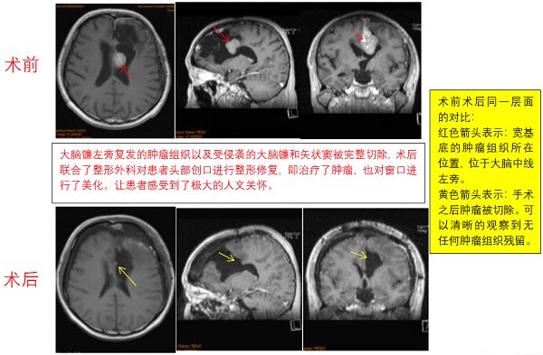 关于脑膜瘤你需要知道的那些事儿|科普| 中颅窝