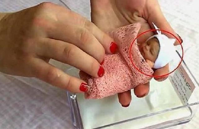 睡眠时间|14年前的“巴掌女婴”,出生只有半斤重,现在怎么样了?