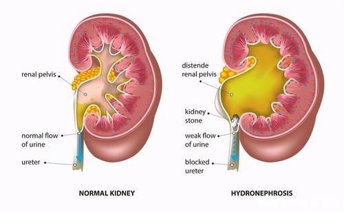 肾炎和尿毒症也就一步之遥!不想遗憾终生,肾炎5个信号别忽略