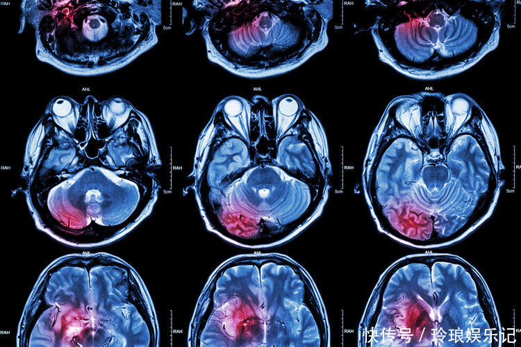 脑出血|高血压不想脑出血,医生提醒:4种饮食,2大坏习惯,早戒早安全