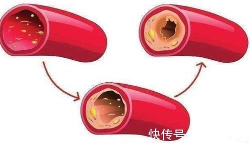 清洁工|血液太稠，担心高血脂，它们被称为血液清洁工，赶走血液里的垃圾