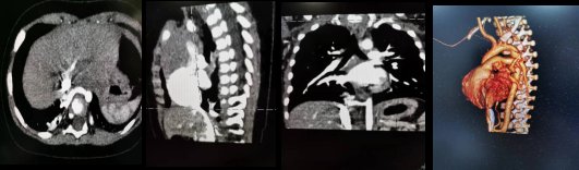 置针|做增强CT，为什么留置针的位置那么重要