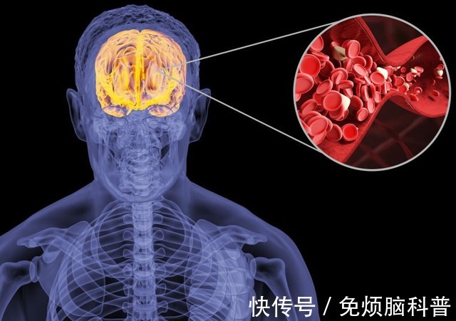 知晓|夏季，58岁男子在厨房做饭，突发脑梗！这四点危险因素要知晓