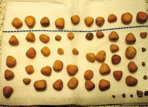 小蓟|体内查出肾结石?只要你能做到这5件事,能够帮助身体排石!