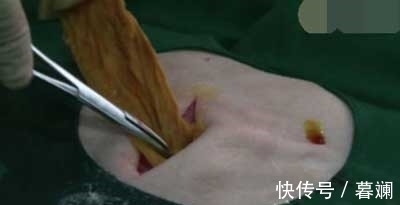 剧痛|剖腹产生下儿子后,腹部剧痛难忍,医生再次打开肚子,吓得傻了眼