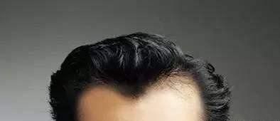 种植|天生发际线高还有救吗?试试发际线补发和自体头发种植,非常实用