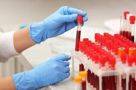 怪状|血脂高的人，头上会有5种“怪状”，学会3招，不怕脑梗找上门