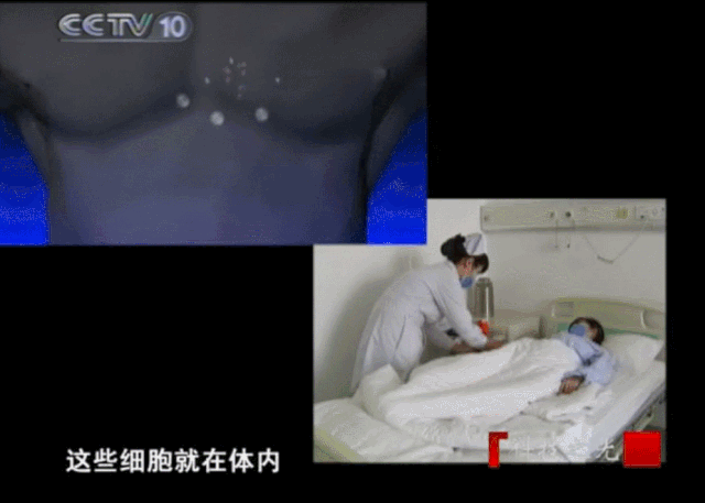 央视CCTV:癌症女孩六年多次大手术,免疫疗法助她重获新生