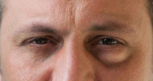 心脏病|“心脏不好脸先知”,脸上出现以下3种变化,赶紧及早查一查