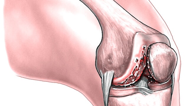 退化性关节炎|人为什么会得关节炎医生关节炎可不是“一个”病