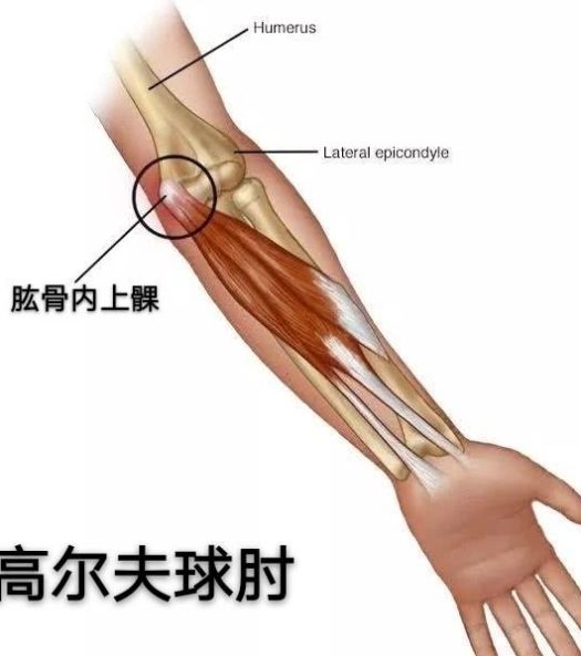 肘关节痛 可能是 高尔夫球肘 在作祟 几种最佳治疗手段消除它 快资讯