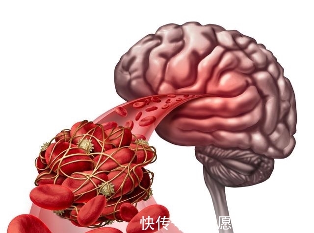 马铃薯|中风容易引起半身不遂与猝死,中老年要牢记三补三降一运动