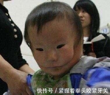面部|23岁产妇生下一名“面具婴儿”面部断裂害怕人,医生:都是妈妈惹的祸