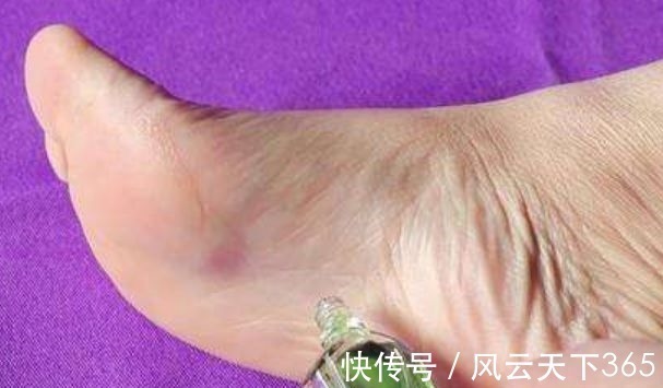 睡眠质量|家中常备风油精,涂在脚底坚持7天,看见效果老中医都说好!