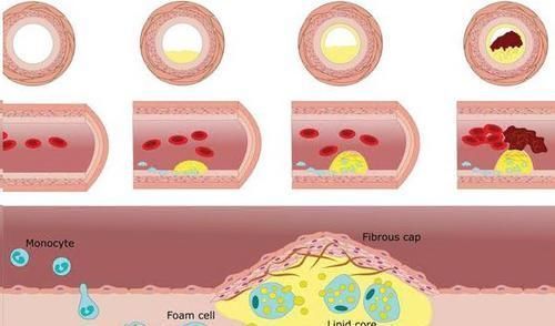 甘油三酯的“头号强敌”发现,没事喝两口,血管畅通,血栓绕道走
