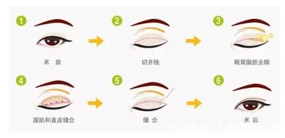 纱布 割双眼皮的注意事项有哪些?做好这些注意事项,术后效果倍棒!