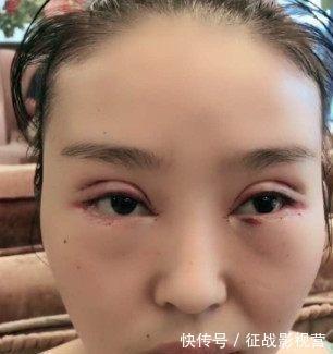 鼻子|女子被男友嫌弃“猪鼻子”，愤怒整容十几次，现在居然成陌陌女神