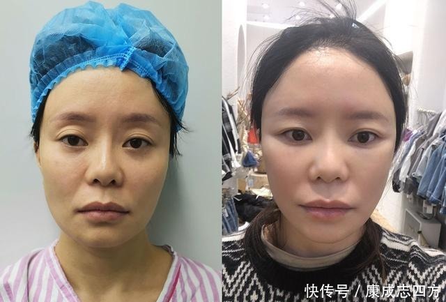 求美者|小拉皮术后1个月,总结几点我的体验感受