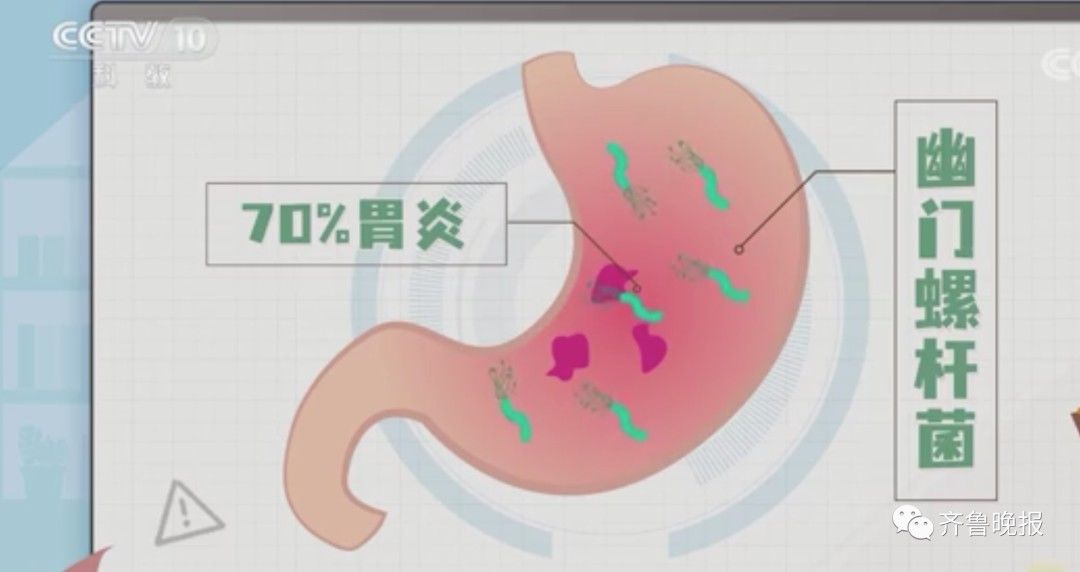 胃癌|它被列为“明确致癌物”！许多人体检都做过这项检查