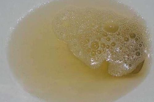 糖尿病患者|患上糖尿病,尿液会发生什么变化?这3个变化还需警惕!