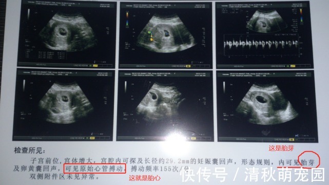 阴超|怀孕多久做B超检查比较好?这份孕早期检查攻略,孕妈们查收学习