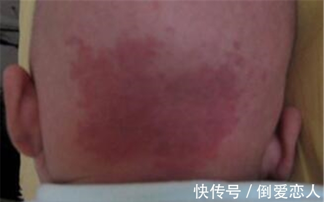 胎记|孩子出生身上有胎记,是孕期做这些事造成的,很多宝妈没在意
