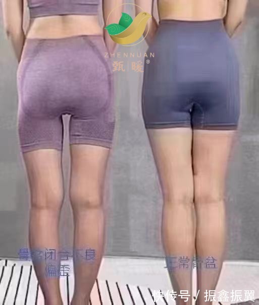 韧带|为什么要做骨盆修复?是交智商税?甄暖知识分享