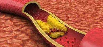 脑梗|血液粘稠的人，别喝3种水，多吃2物，软化血管，防脑梗