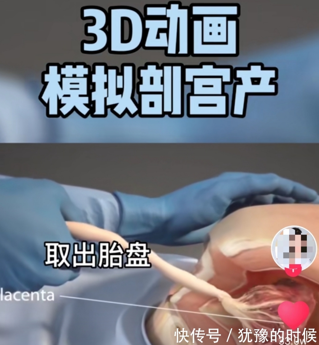 顺产|剖宫产有多“伤”妈妈,几张3D过程图带你了解,感恩老婆和妈妈