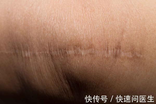 尿管|剖腹产真的比顺产轻松吗?产妇在3个时刻,会痛得咬牙