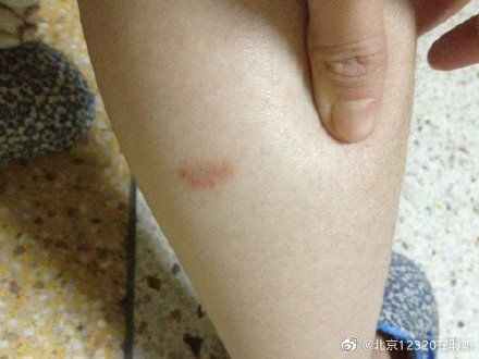 神经性皮炎|什么是神经性皮炎?