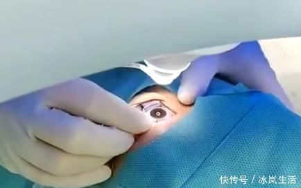 手术室|做近视手术到一半,如果眼睛动了、眨了,会怎么样?