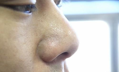 毛孔粗大、黑头多，该怎么办？平时该如何清洁脸部肌肤？