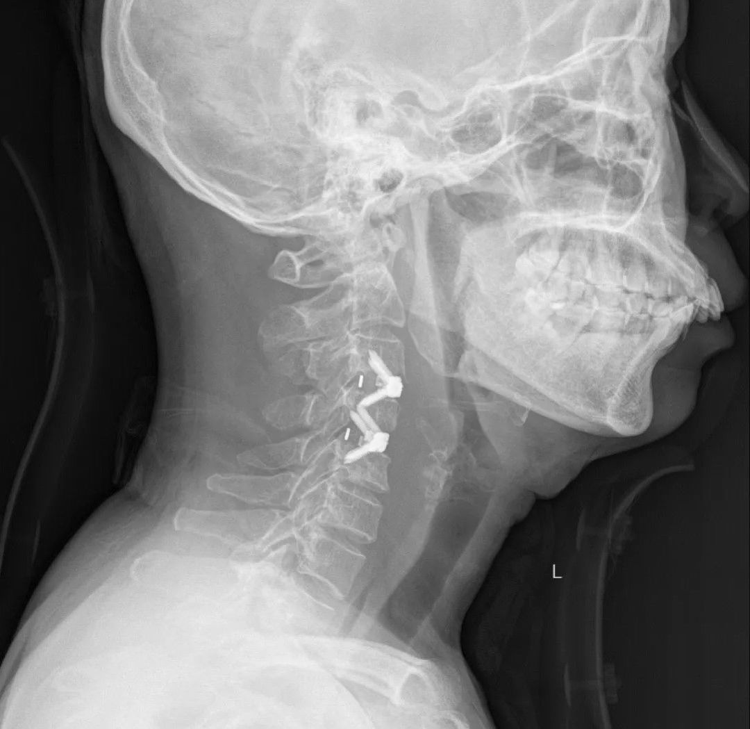 颈椎结核|因为这......她的两节颈椎被“吃掉”,差点瘫痪!