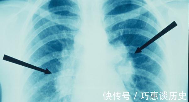 肺结节|千古一味“喜怒”草!清肝热、散肝郁,特别适合肺结节患者