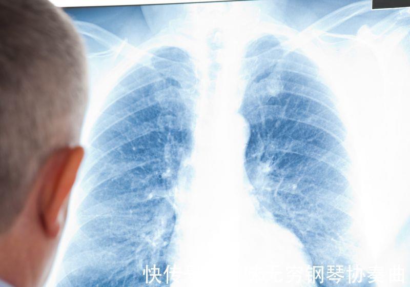 恶性肿瘤|肺癌早期如何筛查？哪些人需要每年做胸部CT检查？医生告诉你答案