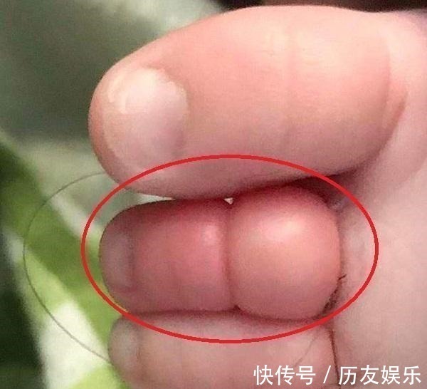 宝宝|11月龄宝宝脚趾进“虫”,家长紧急送医,医生直言幸好来得早
