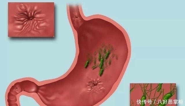 胃痛|幽门螺杆菌怕1种水,你若爱喝,胃痛胃酸远离你,胃越来越好