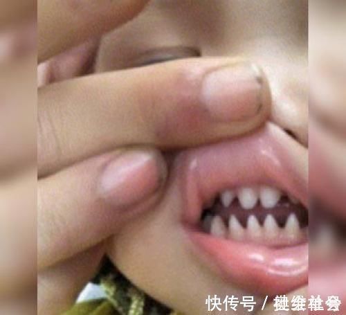 鲨鱼牙|萌娃张口的一瞬间令人诧异,牙齿像“鲨鱼牙”,网友:父母惹的祸