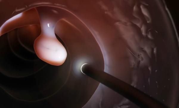 癌前病变|四个部位长息肉，最好及时做手术切除，久而久之可能发展成癌症！