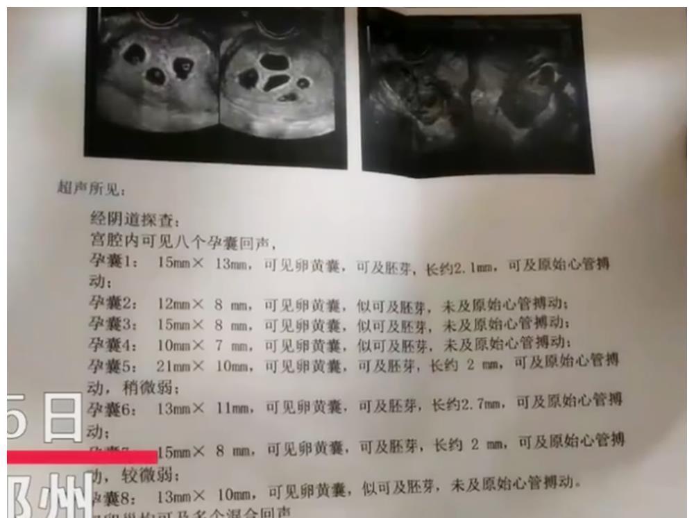 八胞胎|女子怀上“八胞胎”又惊又喜,自己表示想留4-5个,婆家却不同