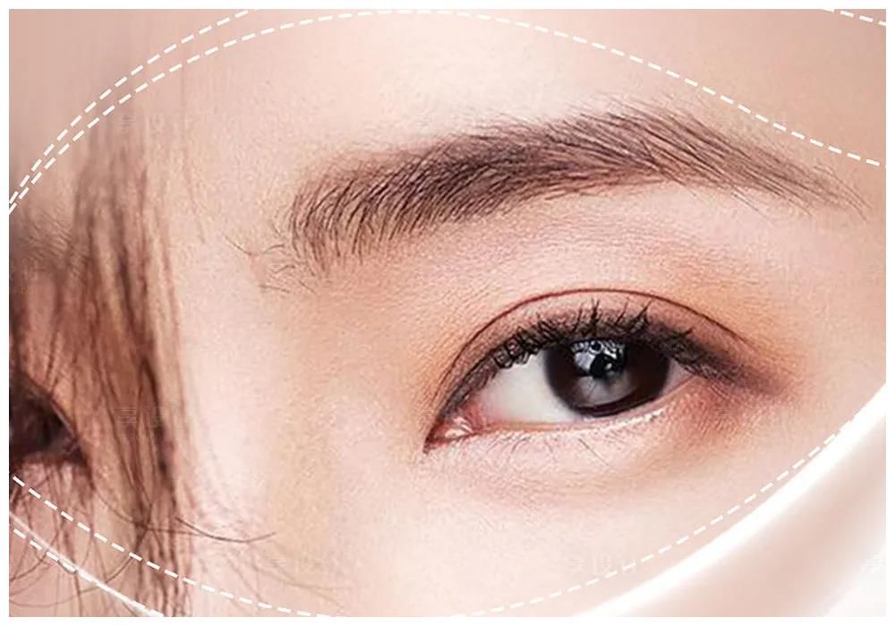 内双与单眼皮割双眼皮有何不同？