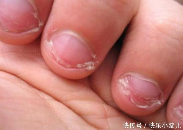 手指甲|从小“咬指甲”的孩子,长大后会变成啥样专家逃不过2种结局