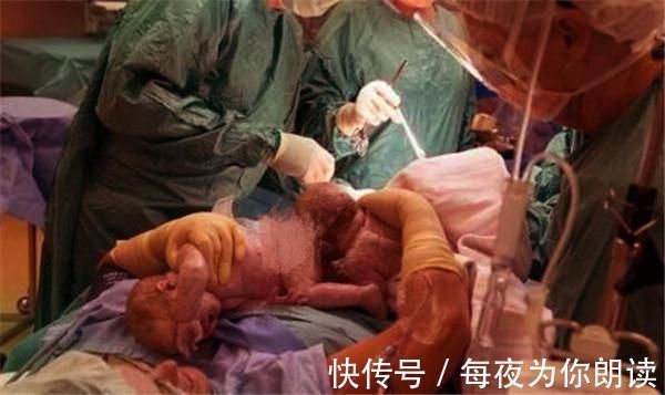剖腹|孕妇怀孕8个月摔倒大出血，胎儿没有生命体征，剖腹却有意外收获