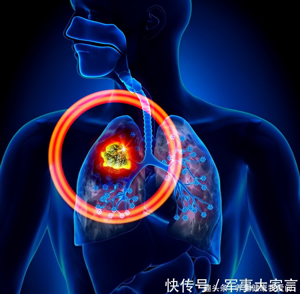 李明|打破肺癌晚期最多存活半年“魔咒”，晚期癌症带瘤生存4年病例